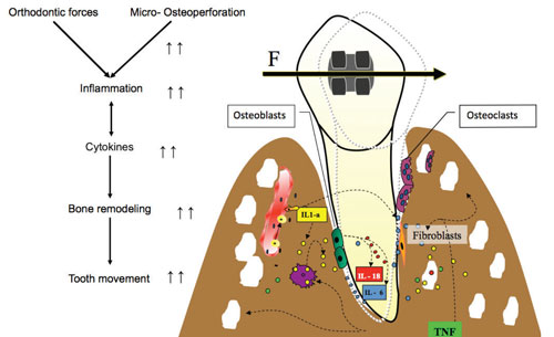 Figure 1: The biology of tooth movement with micro-osteoperforations (MOPs). 