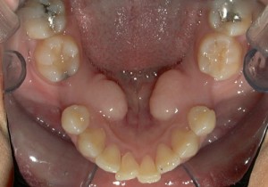 Figure 2: Large molar spaces
