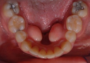 Figure 3: Molar spaces closed in 8 months with Damon TADs and use of Propel. 