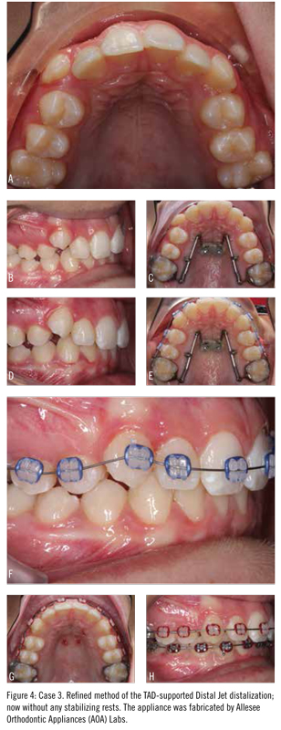 Align Technology Introduces Invisalign Moderate Package