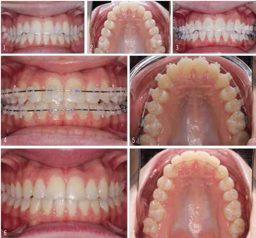 Figure 1: The initial photos demonstrate the flared appearance of the anterior teeth and the constriction of the posterior maxilla. Image 3 shows how Clarity ADVANCED brackets disappear into teeth when viewed front on; images 4 and 5 show later progress in treatment. The final images show the reduced flare and wider smile, achieved in just 5 months. 