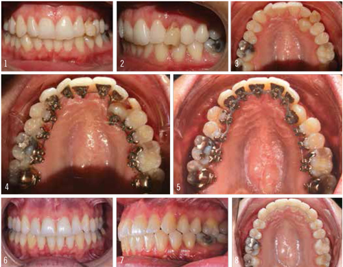 Figure 2: The initial photos show the awkward appearance of the primary left canine. Over the course of 19 months, lingual braces were used to bring both the crown and the root of the adult canine forward. Images 6 and 7 show the healthy appearance of the root of the tooth. 
