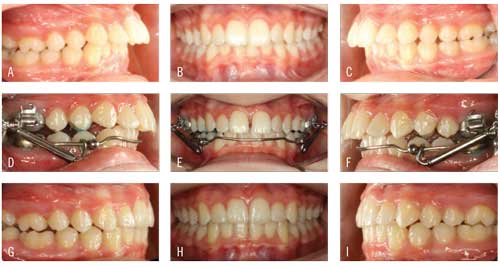Figure 4. (A-C) Patient presents with Class II malocclusion. (D-F) Esprit springs added to the Xbow at 6 weeks. (G-I) Patient following treatment with Xbow and Esprit for 5 months, Avex MX for 9 months, and AcceleDent. 