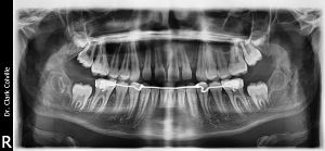 Figure 5: Panoramic x-ray showing the mesial of the cuspid root.