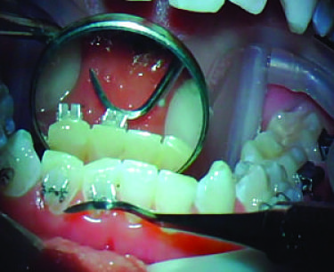 Figure 1: Brackets precoated with APC Flash-Free Adhesive require less force to place on the tooth because there is no flash to extract.