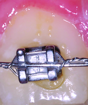 Figure 2: Brackets coated with traditional adhesives, like the image above, require extra time to remove excess flash, a process that can also move the bracket out of position.