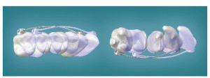 Figure 2: Occlusal view of the animation of the molar movement.