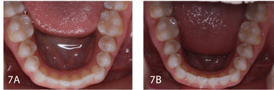 Figure 7A: Patient presents with crowding. Figure 7B: The case was treated over 4 months by tipping to align the teeth and some minor interproximal contouring.