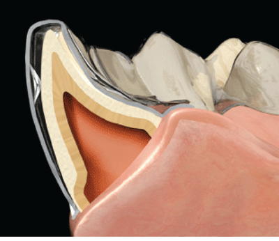 Figure 2: Pressure point with narrow contact surface for 0.3 mm of tooth movement.