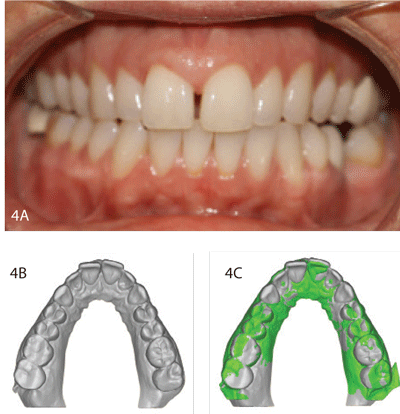 Figures 4A and 4B: The goal was to realign the anterior teeth and close the diastema. Figure 4C: The heat map shows progress of the correction. Figure 5: This case shows correction of a mild rotation due to orthodontic relapse from a previous corrected position.  