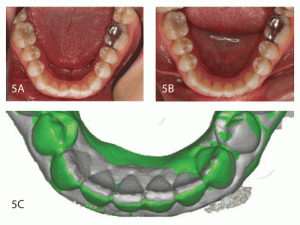 Figure 5: This case shows correction of a mild rotation due to orthodontic relapse from a previous corrected position.