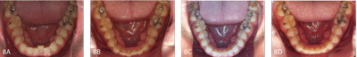 Figure 8A to 8D: Case depicts a more significant failure in the alignment of the lower incisors. The figures show treatment at 0, 4, 5, and 6 months of treatment.