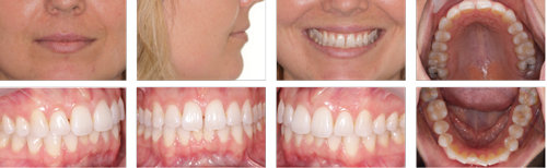 Figure 1: A 32-year-old female patient presents with a Class I malocclusion. Her main concerns were lower anterior crowding and the upper anterior space between her front teeth. The patient had previously worn traditional braces and did not want to do so again. 