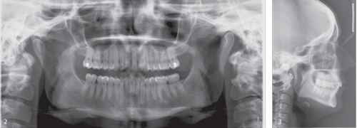 Figures 2 and 3: Radiographic exam confirmed a Class I malocclusion with mild upper misalignment and a 1.5-mm diastema between #8 and #9, as well as mild tapering of those teeth. The lower arch displayed moderate anterior crowding and a single tooth right posterior cross bite of tooth #2 and #3.  