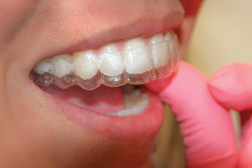 Patient E wearing a thermoplastic retainer filled with  Recaldent