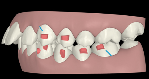 invisalign button rubber bands