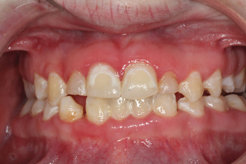 Intraoral anterior photograph of a Down syndrome patient showing the adverse effects (decalcification) of poor oral hygiene aggravated further by chronic mouth breathing.