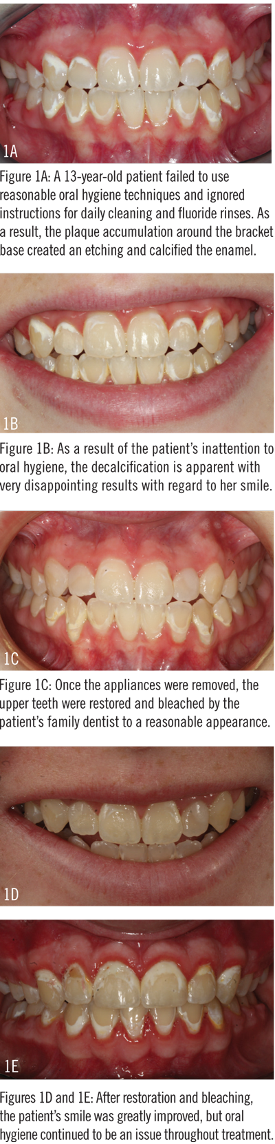 Oral Hygiene During Orthodontic Treatment