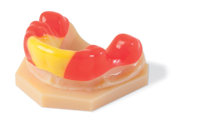 Once the model has printed, users of Stratasys’ printers can fabricate custom orthodontic appliances like this mouthguard.